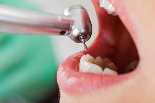 Best Emergency Treatment for Dental Infections or Abscesses in Joshua, TX
